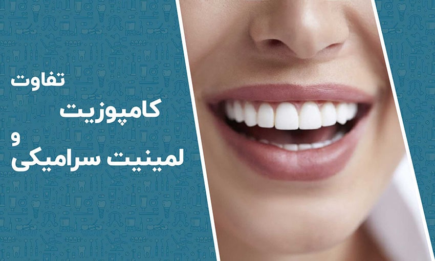 فرق لمینت و‌ کامپوزیت دندان